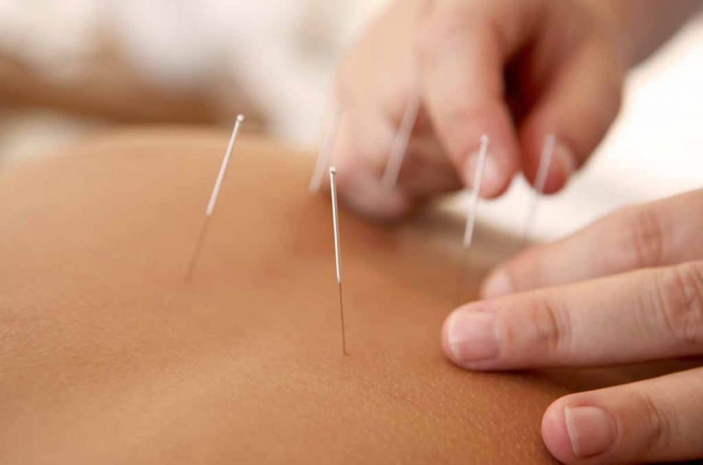 analgesia acupuntura